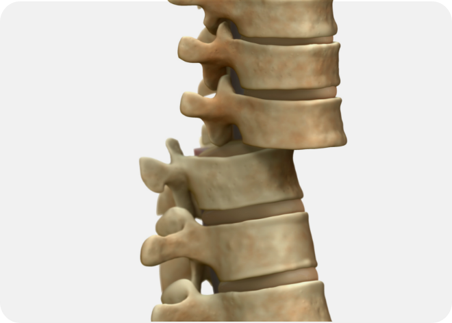 척추전방전위증