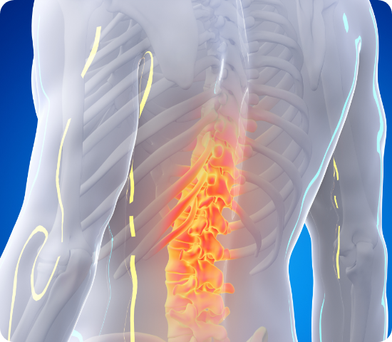 허리디스크 이미지