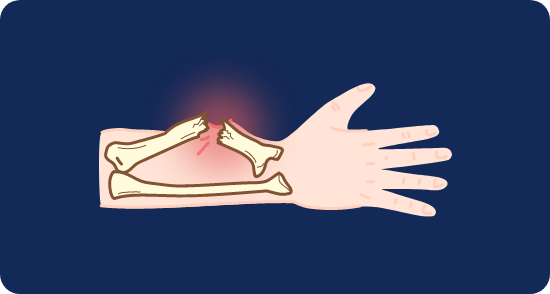 개방성 골절